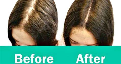 How To Regrow Hair Best And Natural Ways To Regrow Hair Before And After