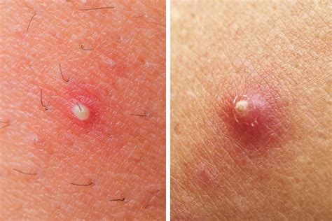 The Difference Between A Pimple And A Boil Readers Digest
