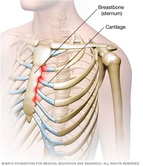 Fuentes externas (español → inglés)(es → en). Mejores 35 imágenes de Síndrome de Ehlers Danlos e ...