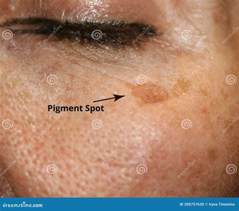 Brown Spot On The Skin Of The Face Pigmentation On The Skin Stock