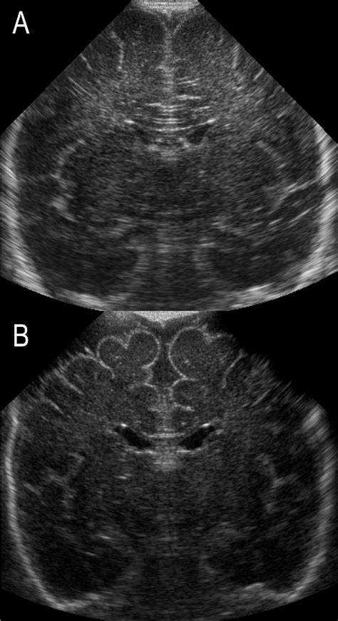 Figure 1 From Sequential Cranial Ultrasound And Cerebellar Diffusion