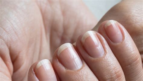 Bruzdy na paznokciach podłużne i poprzeczne dlaczego się pojawiają