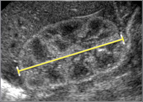 Normal Neonatal Kidney Ultrasound