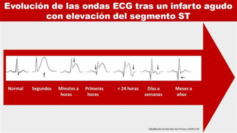 Cardiotruco Evolución De Ondas Ecg En Iamcest Cardioprimaria Ferrol