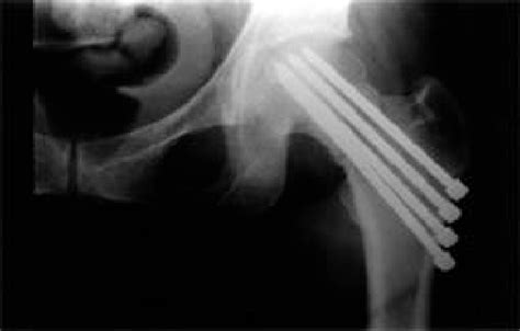 A A A Preoperative Radiograph Of 41 Years Old Female Patient Shows