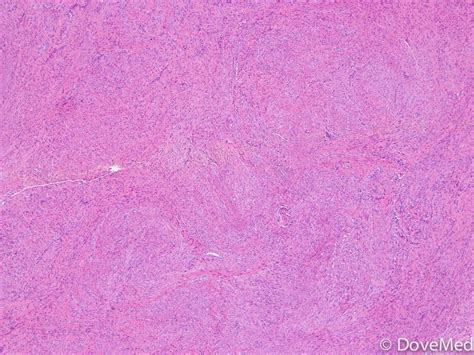 Leiomyoma of Uterine Cervix