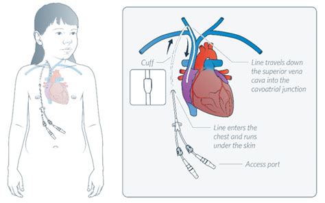 Non Tunneled Central Venous Catheter