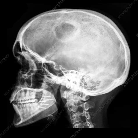 Eosinophilic Granuloma Of Skull Stock Image C0430160 Science