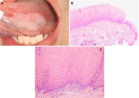 Case 7 A Unifocal Homogenous Leukoplakia On The Left Ventral Tongue B