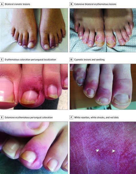 Bilateral Chilblain Like Lesions Of The Toes Characterized By