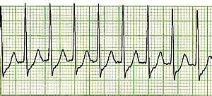 Help us keep the lights on and we'll keep bringing you the quality content that you love! Supraventricular tachycardia - Wikipedia