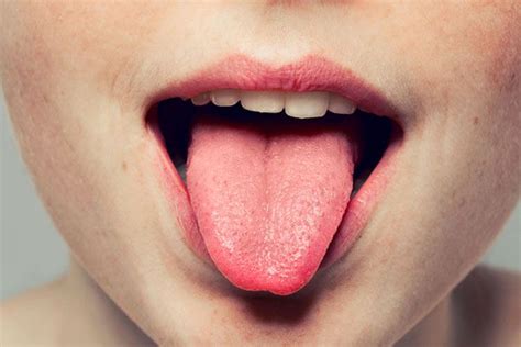 Treatment Of Tongue Problems 14 Effective Ways That Work