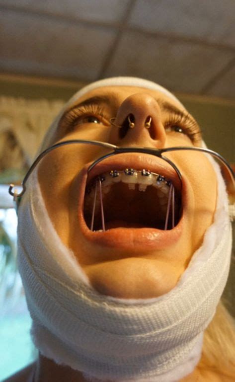 81 Orthodontic Headgear Braces Ideas In 2021 Headgear Braces Braces Girls