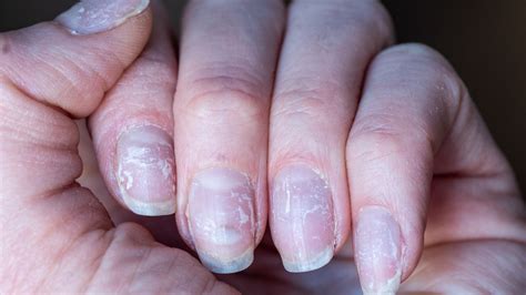 Unlocking The Secrets Can Prenatal Vitamins Rescue Peeling Nails