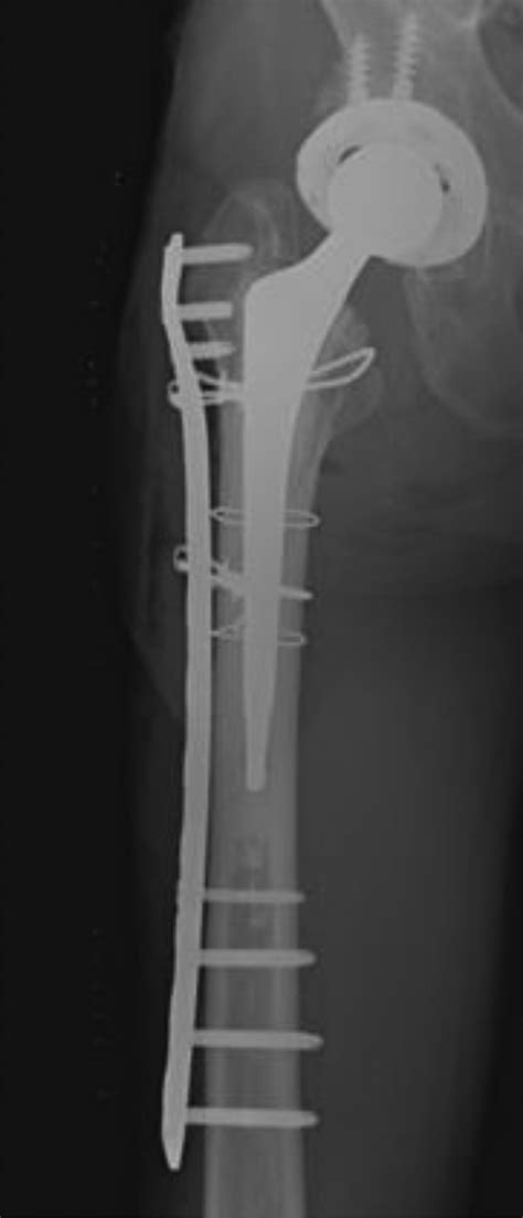 Postoperative Radiographs Osteosynthesis Using A Plate With Cerclage