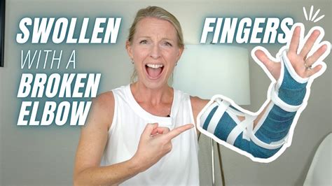 5 treatment tips for swollen fingers after broken elbow why fingers swell and how to help youtube