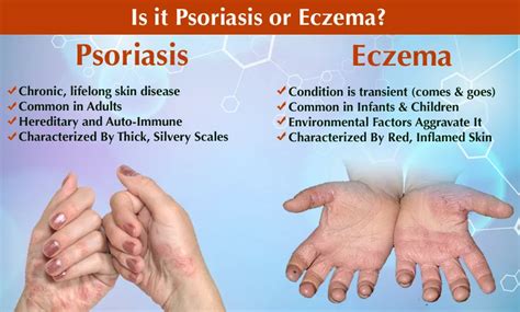 Differentiating Psoriasis And Eczema Symptoms Causes And Treatment