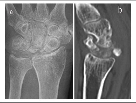 Figure From Comments On Flexor Tendon Rupture Due To Previously Undiagnosed Kienb Ck Disease