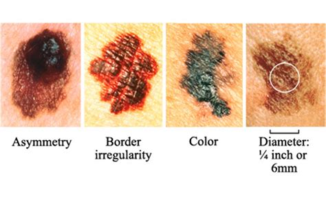 Kolesterol adalah zat yang diproduksi secara alami oleh organ hati, tetapi juga bisa ditemukan dalam makanan yang berasal dari hewan, seperti daging dan susu. Skin Cancer | Infotaucantik