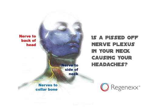Pain In Side Of The Neck And Head Meet The Superficial Cervical Plexus