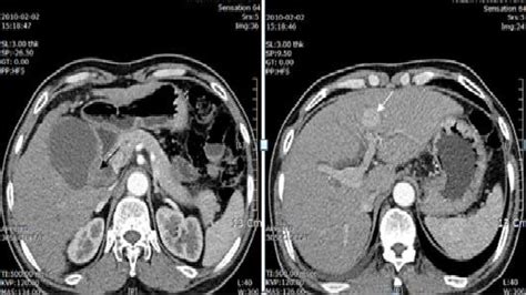 Ct Imaging Results A A Distended Gallbladder With Wall Thickening And