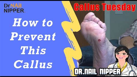 How To Treat Calluses Callus Removal And Prevent This Type Of Callus 47 Callus Tuesday Youtube