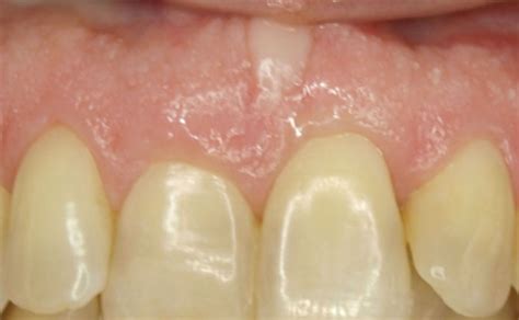 Gingival Cleft Definition Of Gingival Cleft