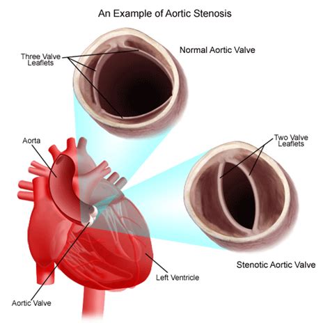 What Is Mild Aortic Stenosis What Activities Should I Avoid Cardiac