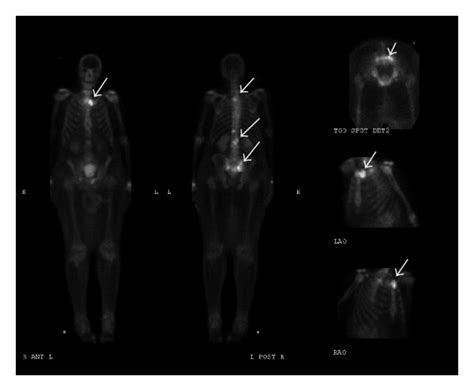 A Illustrated Nuclear Bone Scan With Multifocal Metastatic Disease