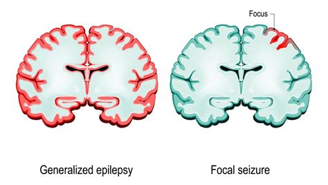 Sudden loss or diminution of muscle tone without apparent preceding myoclonic or tonic event lasting ~1 to 2 s, involving head, trunk, jaw, or limb musculature. 7 Facts About Epilepsy - Health talks