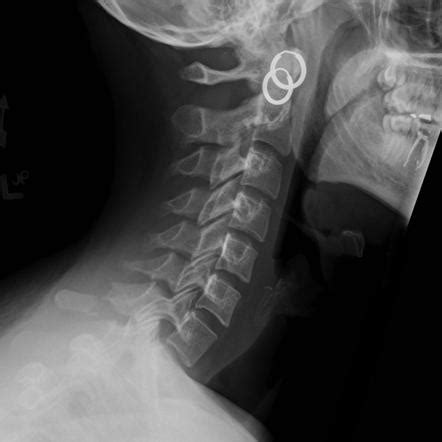 Spinous Process Fracture