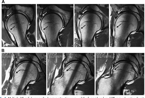 Figure 2 From Mri Of Hip Osteoarthritis And Implications For Surgery