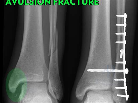 Avulsion Fracture Ankle Treatment Doctorvisit