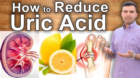 How To Lower Uric Acid And Heal Gout What To Eat Home Remedies And