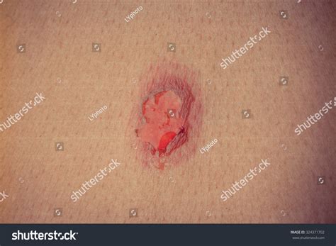View Of The Wound On The Skin Stock Photo 324371702 Shutterstock