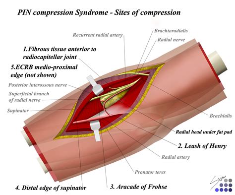 Pin Compression Syndrome Hand Orthobullets