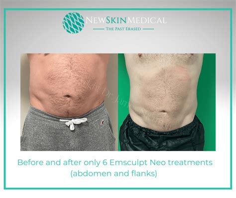 Before And After Emsculpt Neo Target Fat And Stimulate Muscle