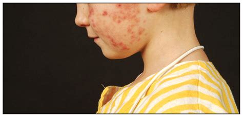 Leukemia Cutis An Unusual Rash In A Child Cmaj