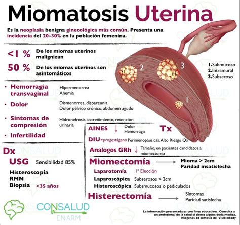Miomatosis uterina Obstetricia Gineco obstetricia Enfermería
