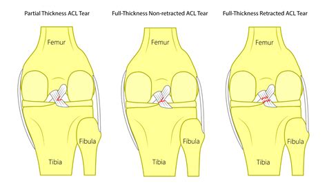 Acl Tear Repair Without Surgery Regenexx