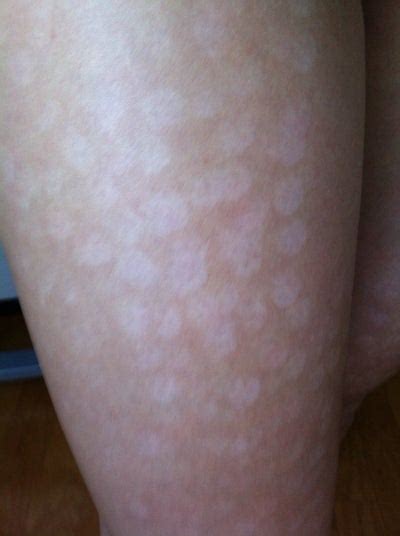 It is a medical procedure that requires training to perform and carries potential risks. Hypopigmentation After Laser Hair Removal Doctor Answers, Tips