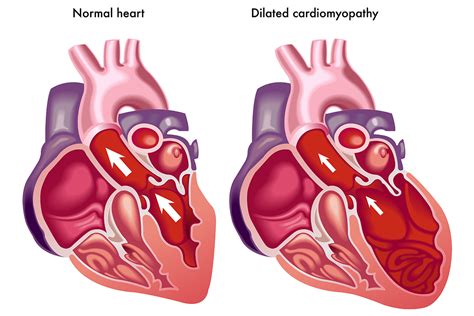 Kardiomiopatie I Zapalenie Mięśnia Sercowego Więcej Informacji