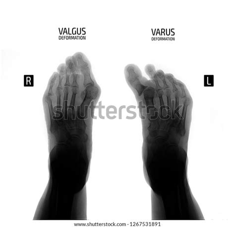 Xray Foot Varus Valgus Deformity 1st Stock Photo 1267531891 Shutterstock