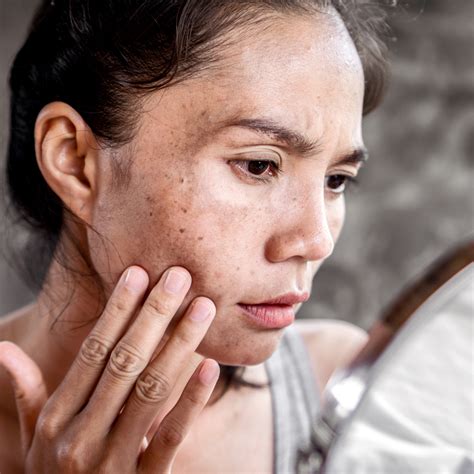 Acne Scar Removal Forefront Dermatology