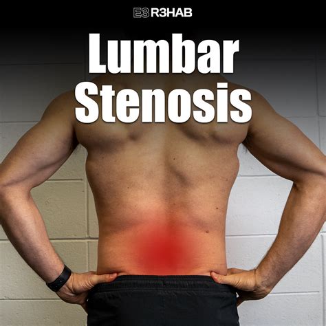 Lumbar Stenosis E3 Rehab