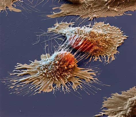 Cancer Cells Under An Electron Microscope Pics