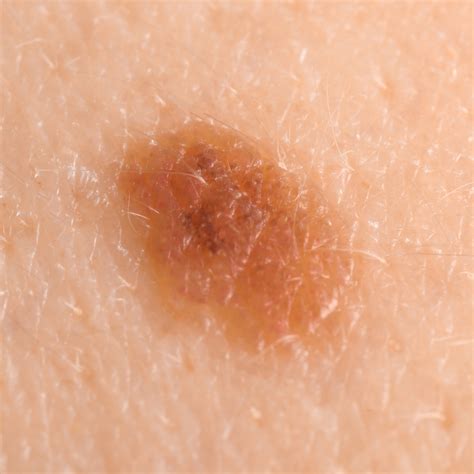 Compound Naevus Mole Spot Check Skin Cancer Aesthetics