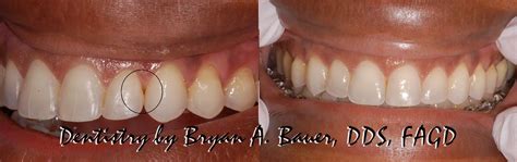 Closing Black Triangles Teeth After Braces Bauer Smiles