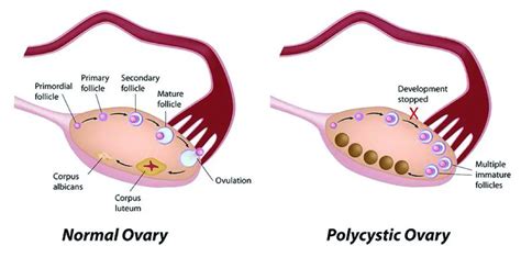 All You Need To Know About Polycystic Ovary Syndrome Pcos ⋆ The Costa Rica News
