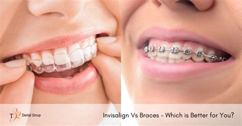 Invisalign Vs Braces Which Is Better For You T Dental Group